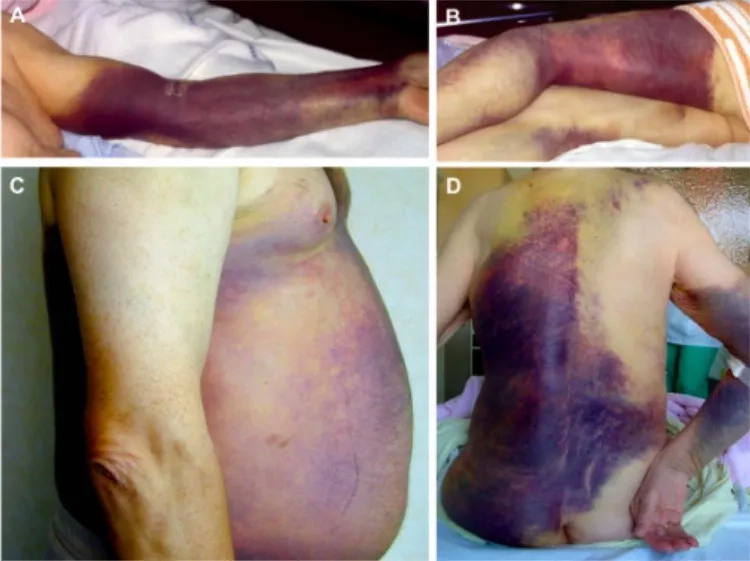 Modern hemophilia treatment options