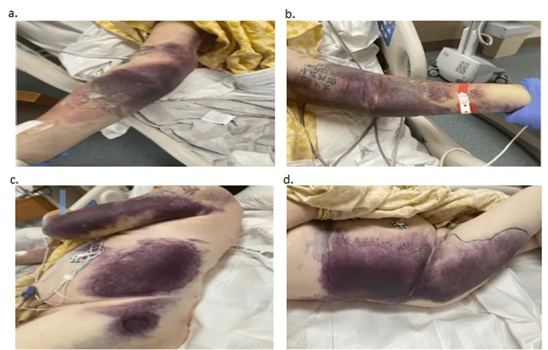 The pattern of hemophilia genetics inheritance