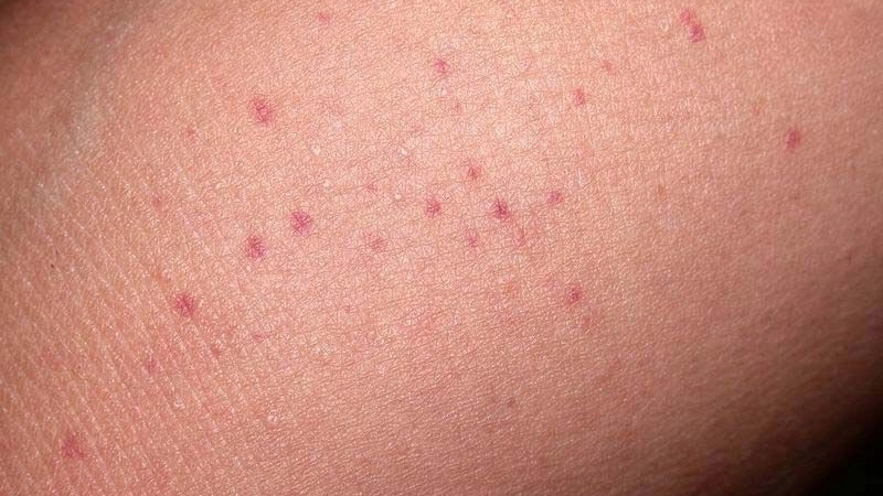 Learn effective HFRS treatment for recovery