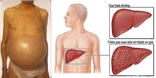 A chart comparing hepatitis a vs hepatitis b