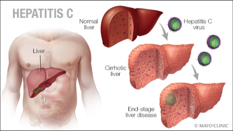 Know Hepatitis C hepatitis C symptoms early