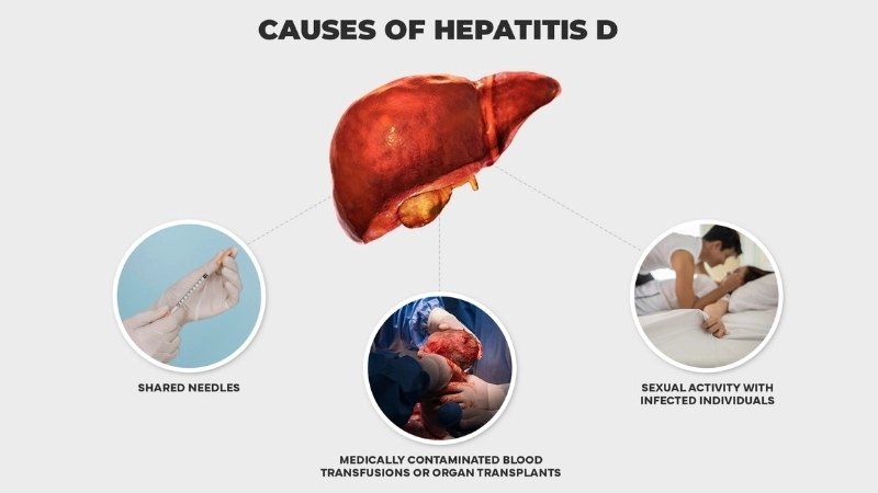 Hepatitis D coinfection with Hepatitis D issues