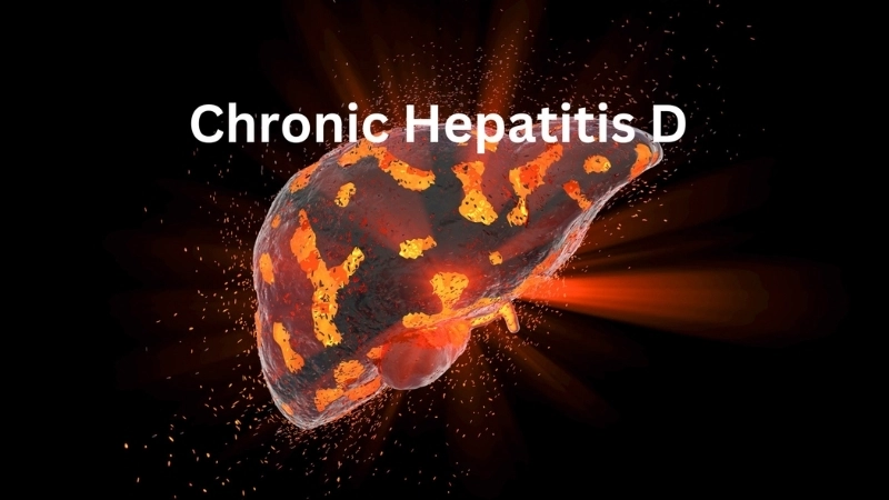 Hepatitis D superinfection and Hepatitis D risk