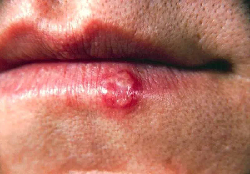 A clear visual depiction of oral herpes symptoms