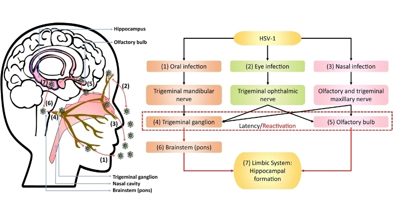 Viral encephalitis affects the brain severely