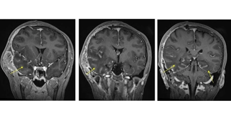 Encephalitis diagnosis needs MRI and lab tests