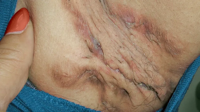 Understanding what hidradenitis suppurativa is