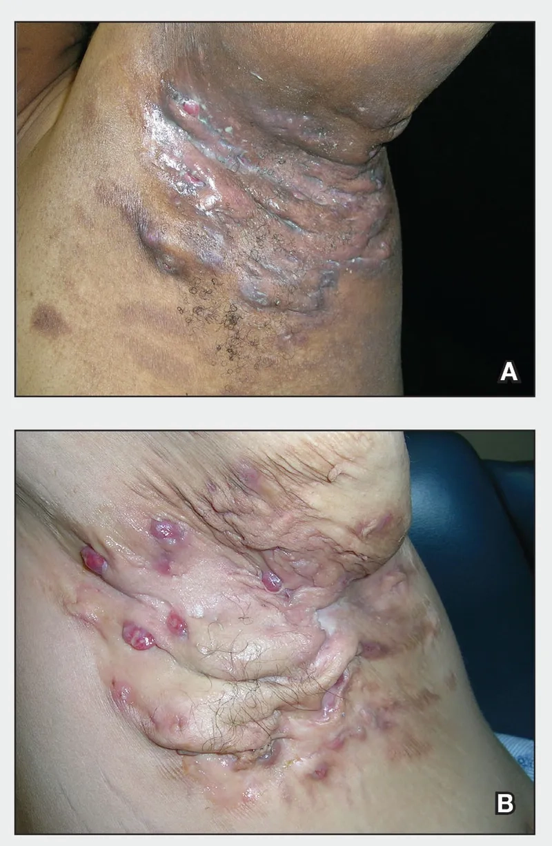 Causes linked to hidradenitis suppurativa