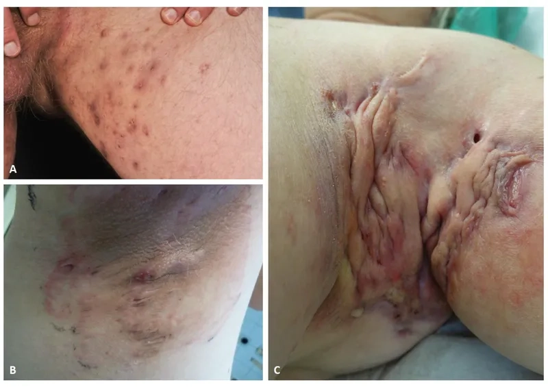 Medical pictures of hidradenitis suppurativa