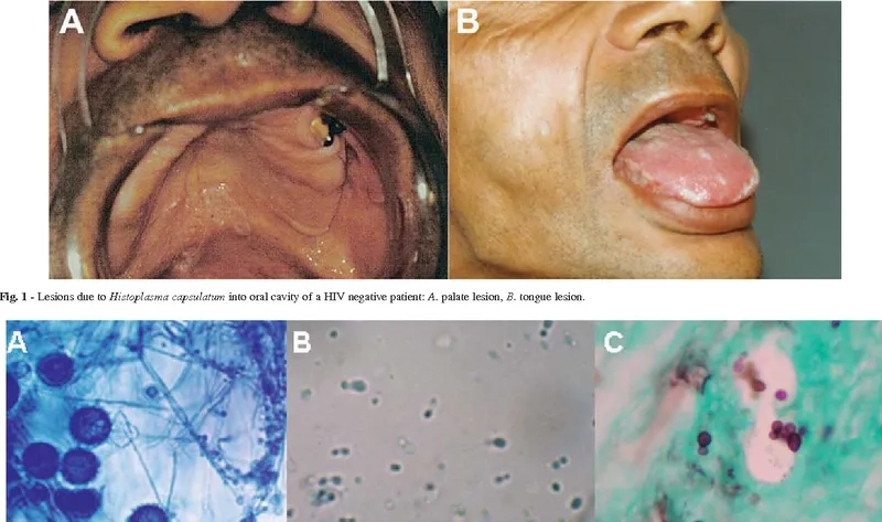 Close-up of ocular histoplasmosis in the eye