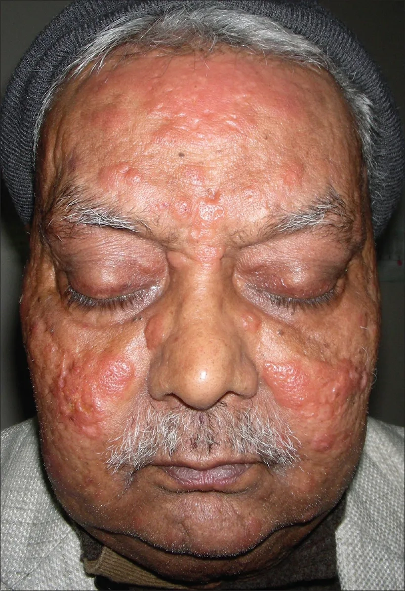 Chart showing common histoplasmosis symptoms