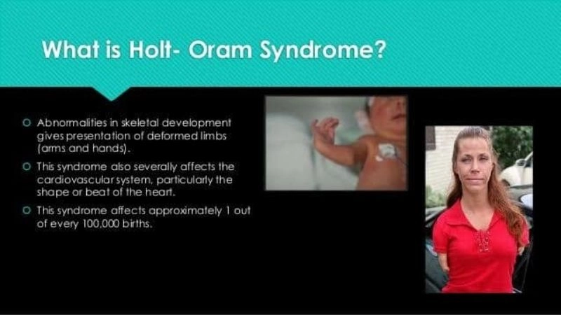 Holt-Oram syndrome diagnosis and evaluation