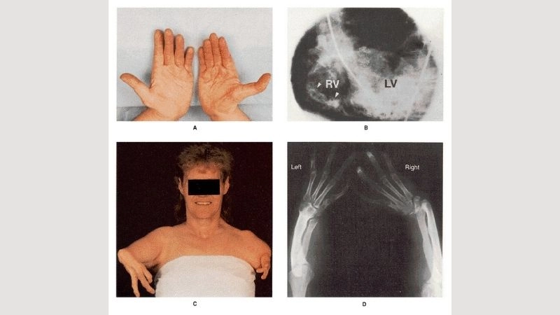 Holt-Oram syndrome T-box 5 gene mutation