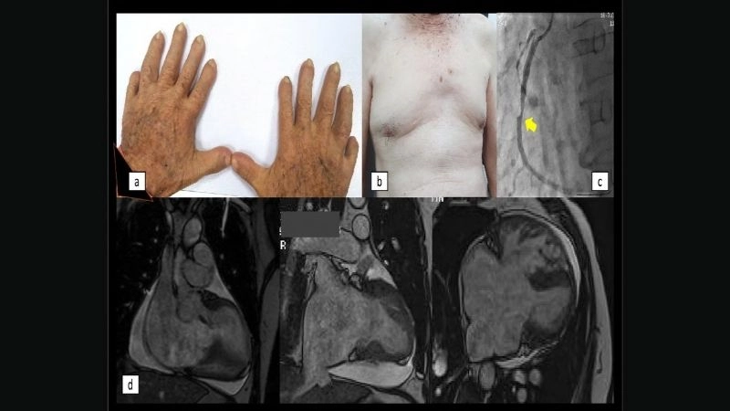 Holt-Oram syndrome prognosis and outlook