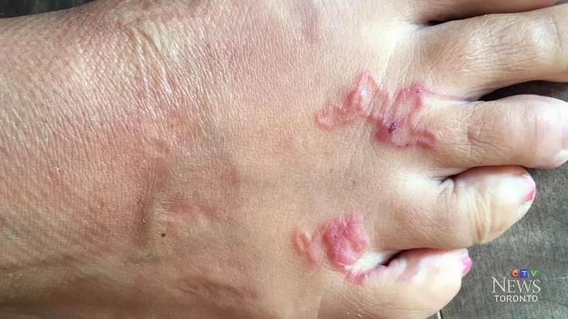 A visual guide to cutaneous larva migrans