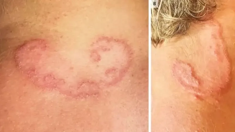 Understanding how do you get hookworms