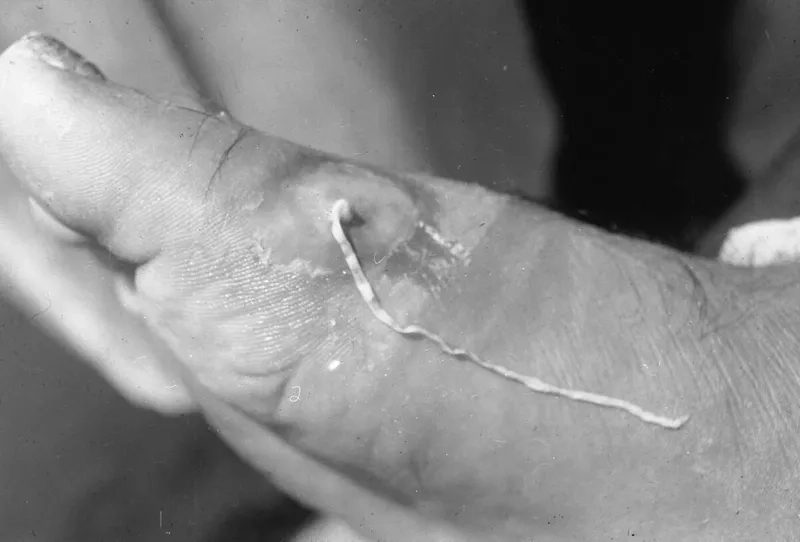 Discussing effective hookworm treatment