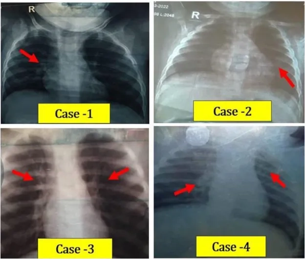Early Bocavirus diagnosis helps prevent complications