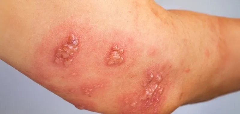 Tips for Bocavirus prevention in daily life