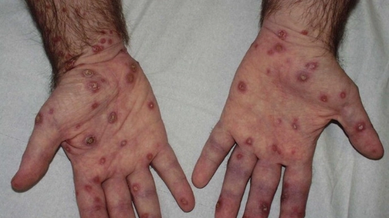 Human Immunodeficiency Virus HIV Infection AIDS HIV opportunistic infections