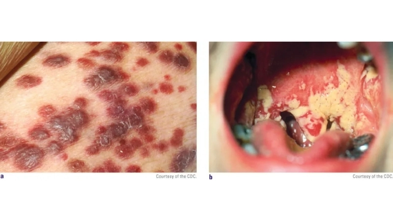 Human Immunodeficiency Virus HIV Infection AIDS living with HIV