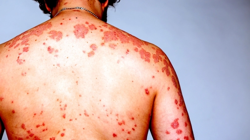 Human Immunodeficiency Virus HIV Infection AIDS HIV prevention