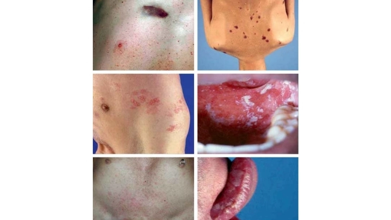 Human Immunodeficiency Virus HIV Infection AIDS HIV testing