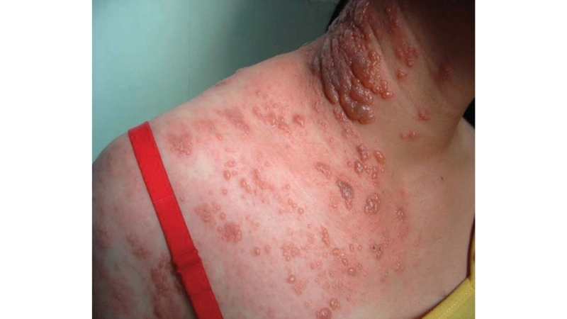 Human Immunodeficiency Virus HIV Infection AIDS PrEP for HIV