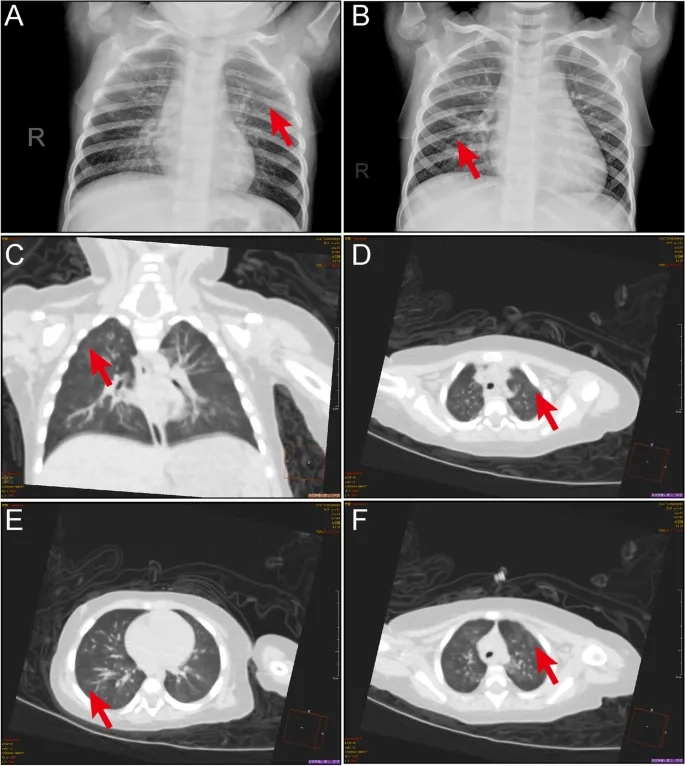 Treating human metapneumovirus in adults effectively