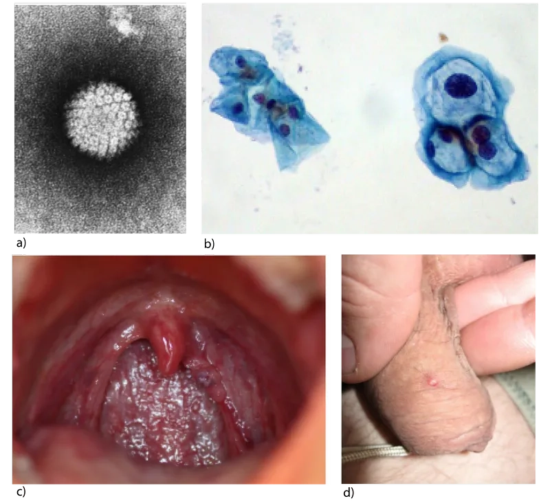 A medical illustration explaining what is HPV