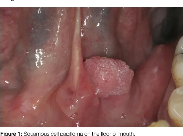 Illustrating how is HPV contagious through contact