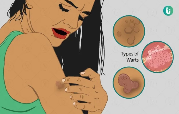 The link between HPV and cervical cancer visualized