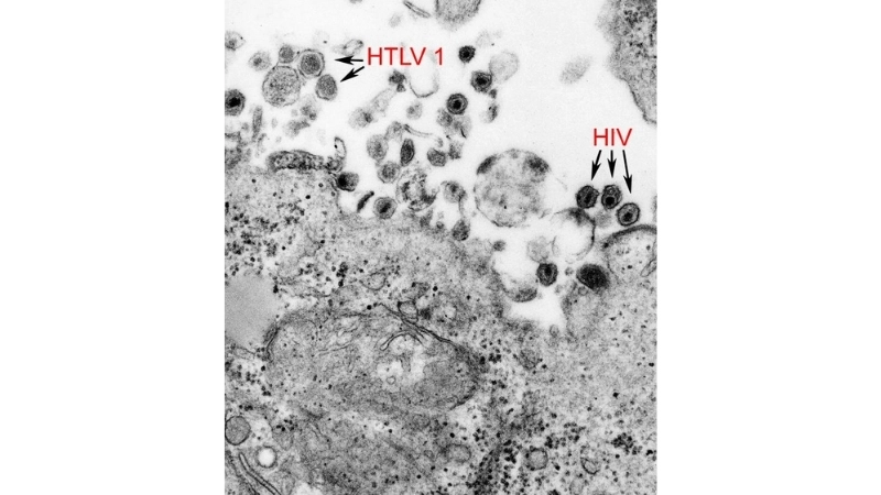 Human T-lymphotropic Virus infection HTLV-2