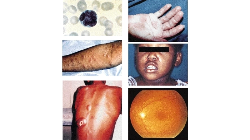 Human T-lymphotropic Virus infection HTLV-1