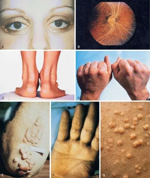 LDL cholesterol shown in cardiovascular health diagram