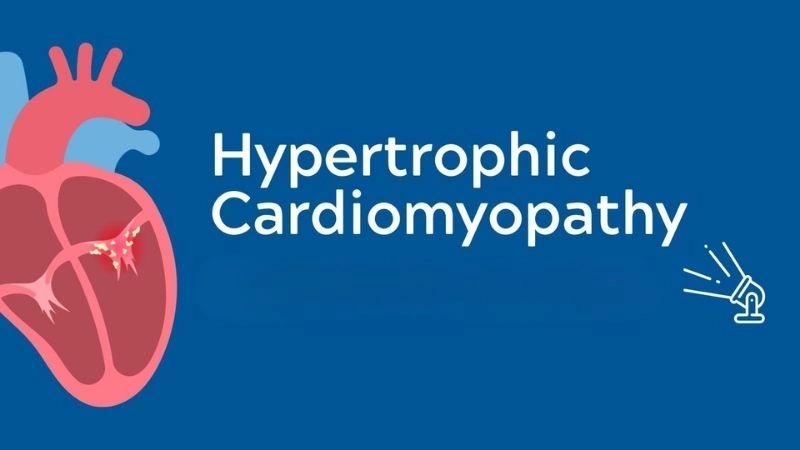 Hypertrophic cardiomyopathy symptoms include chest pain and fainting
