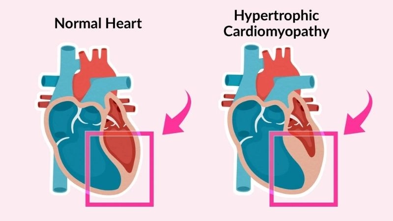 HCM diagnosis uses echo, MRI, and genetic testing