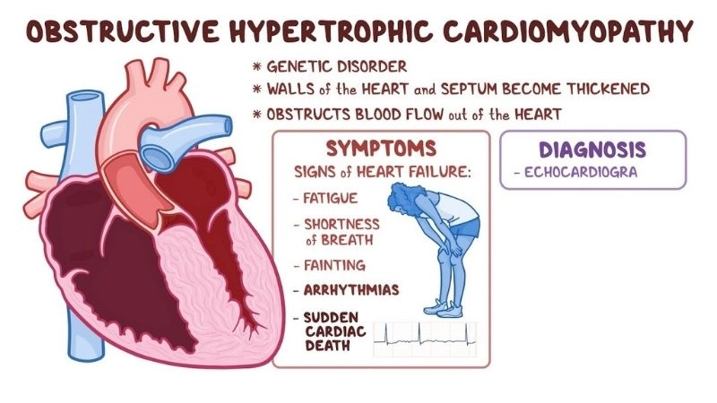 Hypertrophic cardiomyopathy treatment includes meds, surgery, or ICD