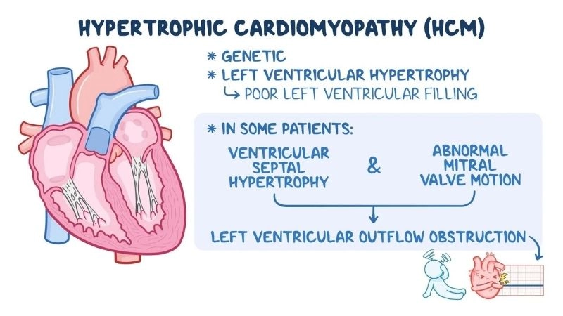 Obstructive hypertrophic cardiomyopathy blocks blood flow