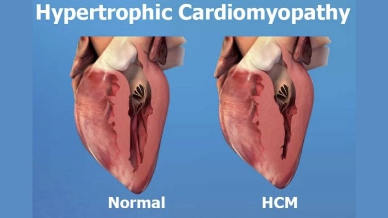 Hypertrophic cardiomyopathy genetics involve sarcomere mutations
