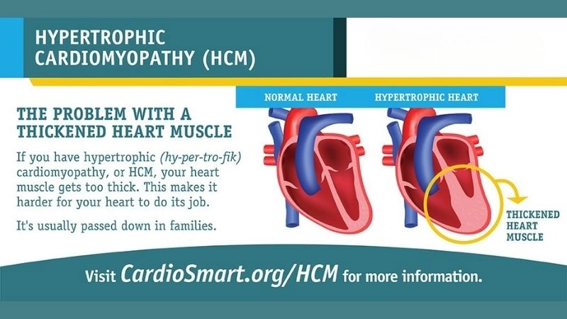 Sudden cardiac death and HCM risk linked to arrhythmias