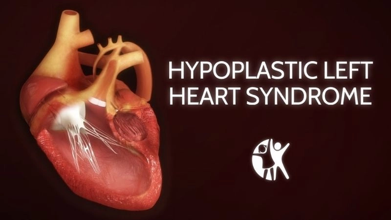 Hypoplastic left heart syndrome symptoms recognizing critical signs