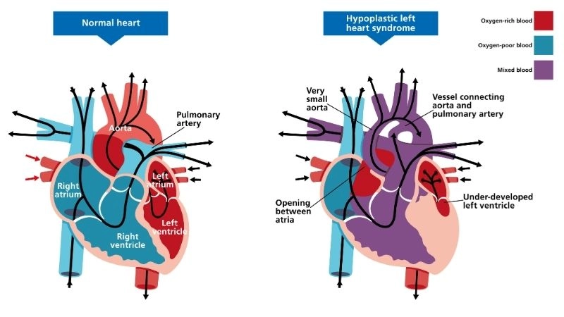 Hypoplastic left heart syndrome treatment life saving options