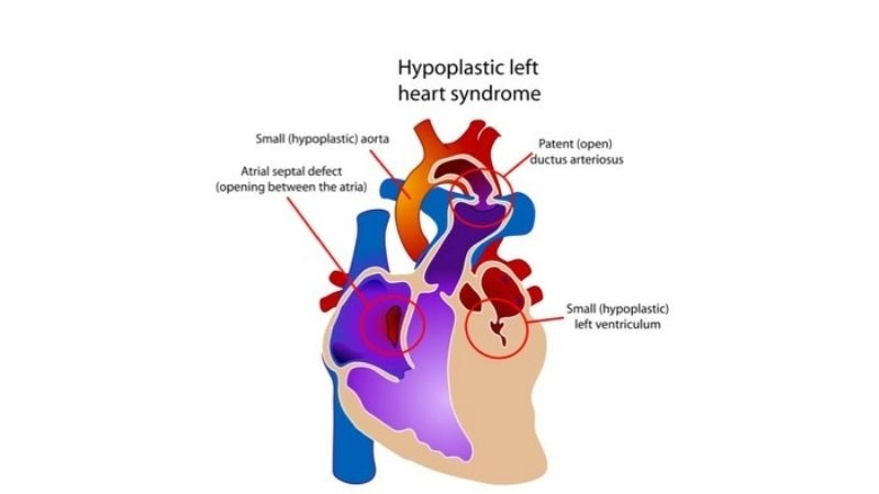 Norwood procedure first stage surgery for HLHS repair