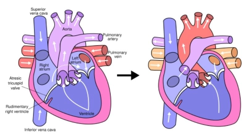 Fontan procedure final stage for hypoplastic left heart syndrome