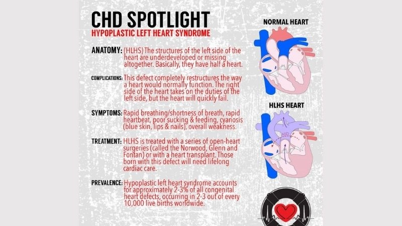 Hypoplastic left heart syndrome prognosis long term outlook