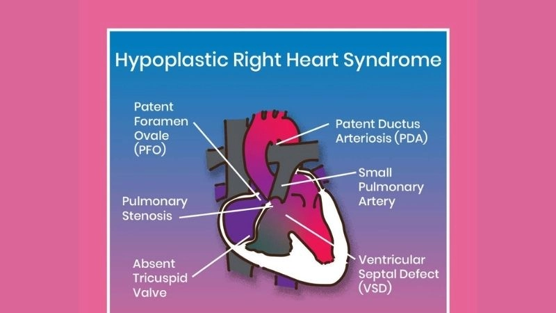 Hypoplastic right heart syndrome symptoms what to watch for
