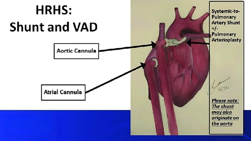 Hypoplastic right heart syndrome prognosis understanding outcomes