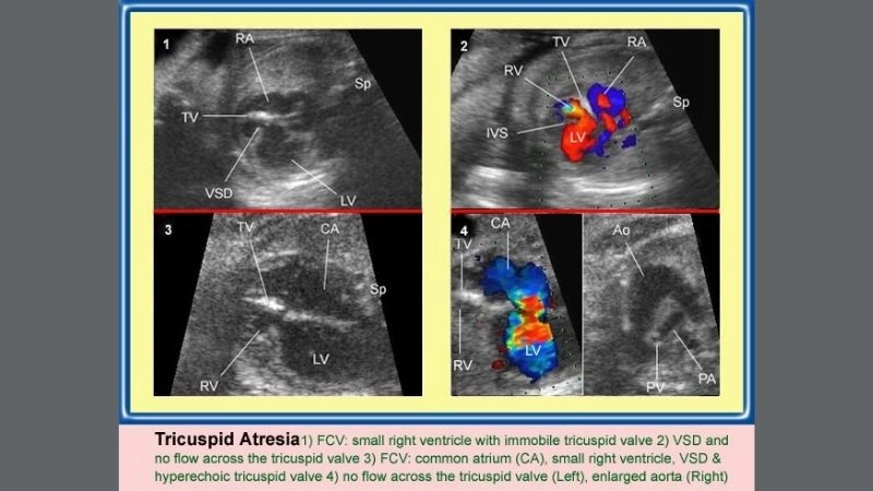 Hypoplastic right heart syndrome surgery staged procedures explained