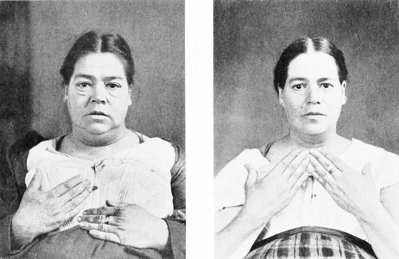 Lab report showing thyroid levels analysis